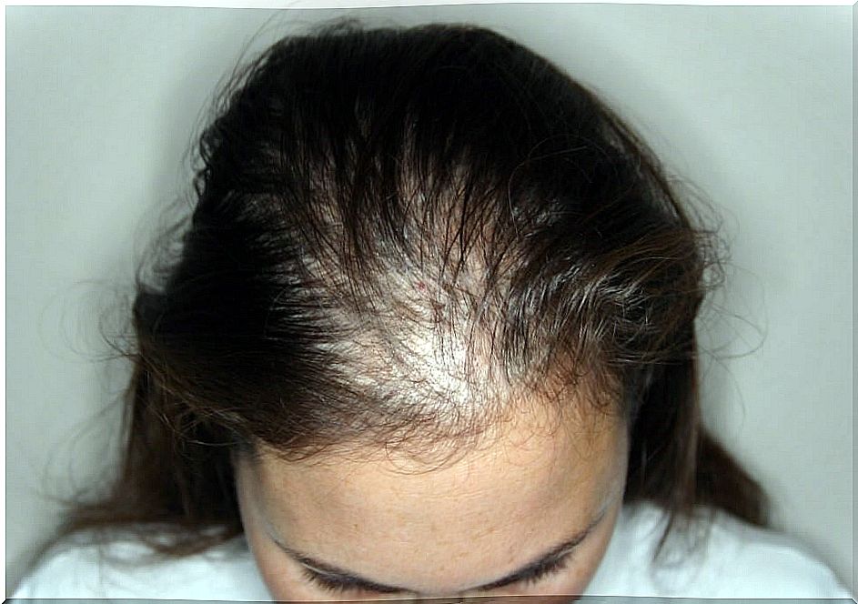 alopecia