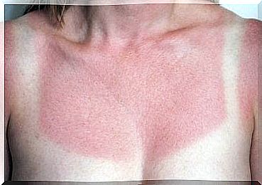 4 home remedies to take care of sunburn immediately