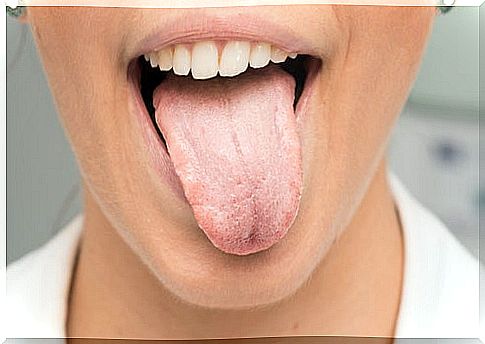 What can cause white tongue