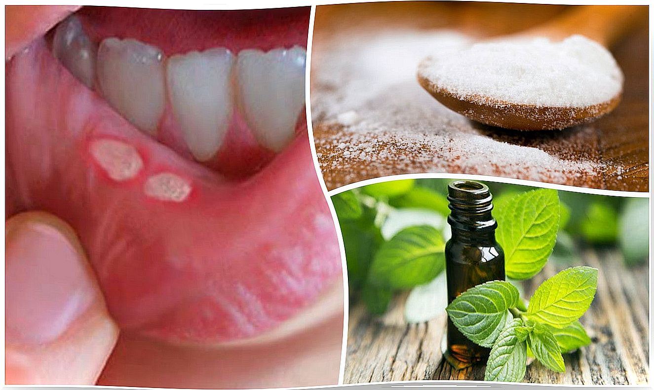 7 home treatments for mouth sores