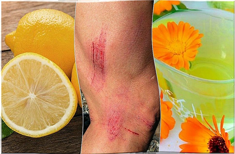 7 natural remedies to heal scratches on the skin