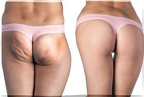 Can natural cellulite treatments be effective?