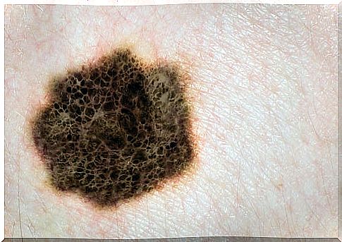 melanoma black tumor