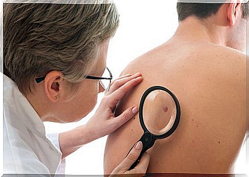 melanoma and moles