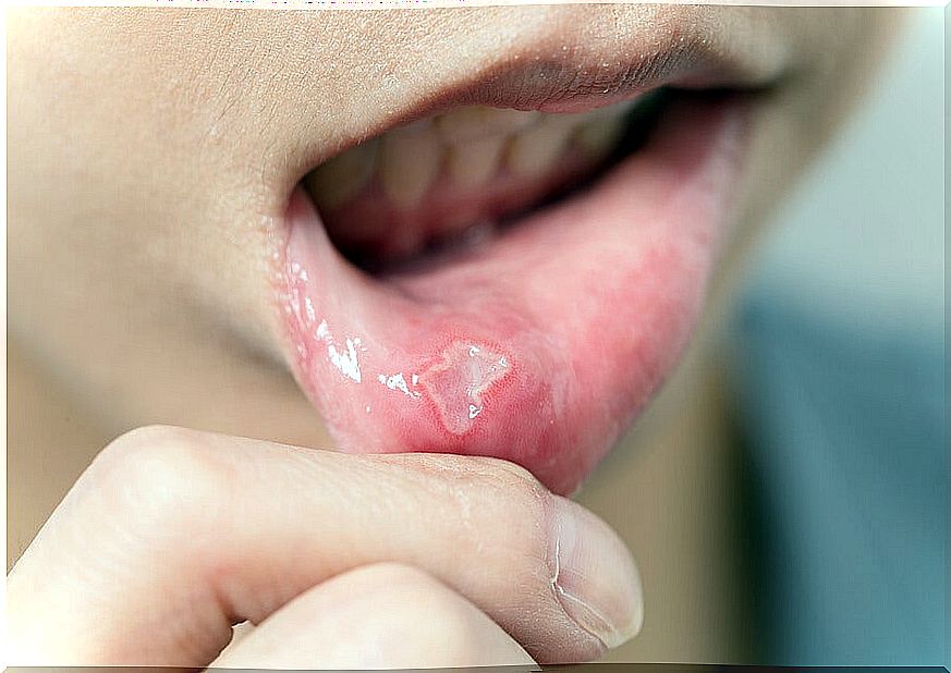 Canker sores in children: how to treat them?