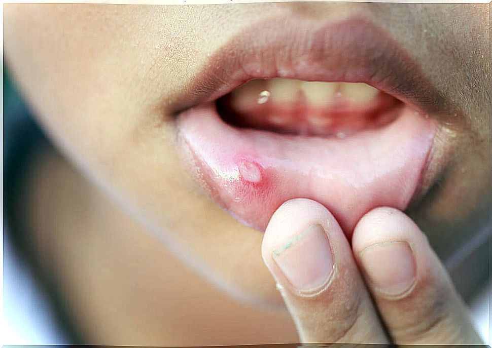 Canker sores or canker sores in children