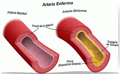 Atherosclerosis is one of the most common heart diseases.