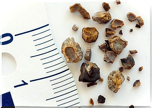 How to prevent kidney stones or kidney stones