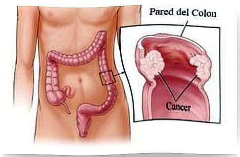 Colorectal cancer