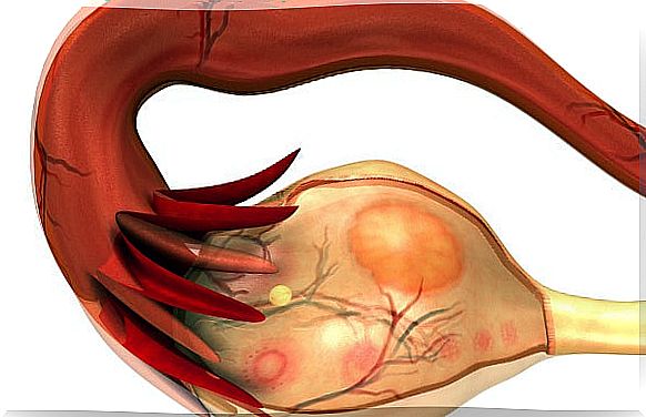 Polycystic ovary