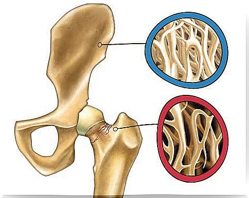 Osteoporosis 