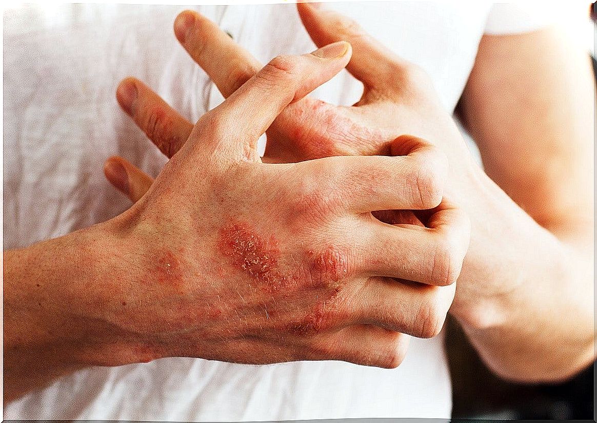 Psoriasis