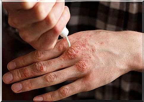 Corticosteroid application in a psoriatic rash