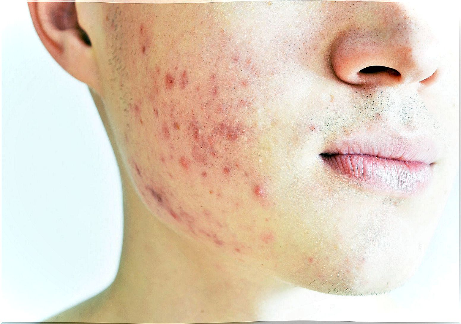 Types of treatments for papulo-pustular acne