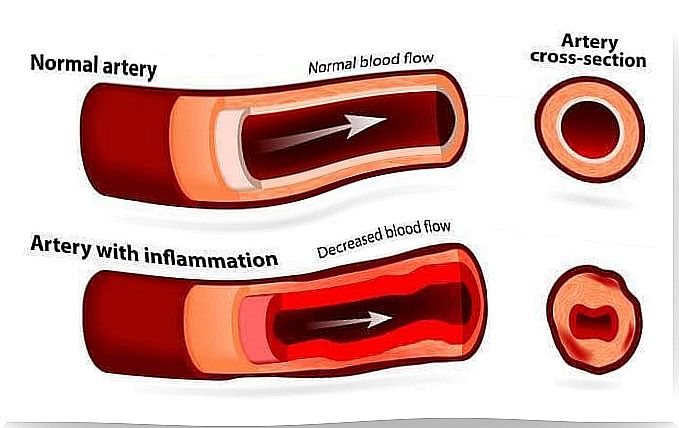 Arteritis 